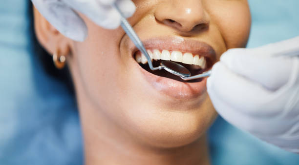 Best Knocked-Out Tooth (Avulsed Tooth) Treatment in Bradenton, FL